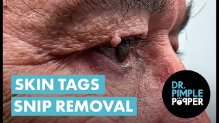 Acrochordon Snip Removal Dr Pimple Popper REMOVES Skin Tags Near Eyes [upl. by Keldah]