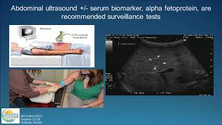 Diagnosis and Screening of Hepatocellular Carcinoma HCC [upl. by Lona]