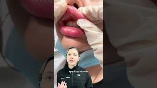 What are the risk of overfilled lip filler Dr Medispa [upl. by Deina]