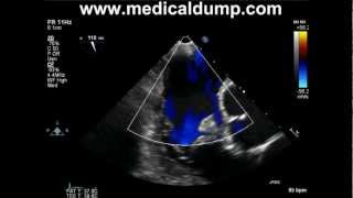 Tricuspid Valve Fibroelastoma  TransEsophageal Echocardiography TEE [upl. by Enner]