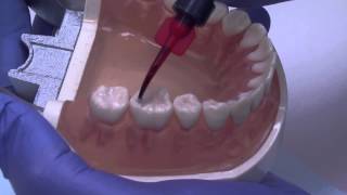 Dental Sealants  Moms Everyday May 2013 [upl. by Kerby]