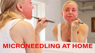 Microneedling DIY at Home  Tips Warnings and Demo  Over 50 [upl. by Sivatco461]