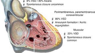 Defek Septum Ventrikel Ventricular Septal Defect  Kardiologi  Anak  Materi Kedokteran [upl. by Adeehsar]