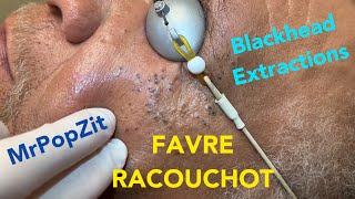 Favre Racouchot syndromeDozens of comedones extractedWhiteheads and blackheads Clearing the pores [upl. by Suivatnad]