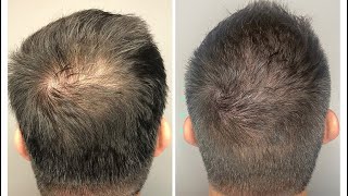 Minoxidil Conflugain Avis  Arnaque  Le Pire Minoxidil  Comment faire pousser sa barbe [upl. by Dnalra]