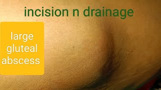 large gluteal abscess  incision n drainage dr youtube doctor [upl. by Herbert534]