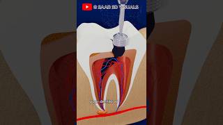 Root Canal Treatment explained in 3d video step by step [upl. by Elladine]