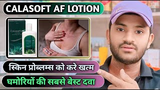 Calasoft af lotion uses dose benefits and Side effects full review in hindi [upl. by Okihsoy]