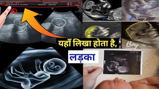 अगर अल्ट्रासाउंड में ये 5 बातें लिखी है तो लड़का ही होगा Baby Boy Pregnancy Ultrasound Report Hindi [upl. by Nafri196]