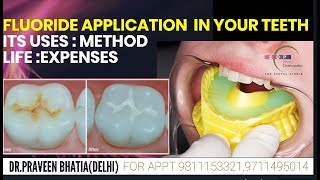 जानें कैसे लगाते है FLUORIDE दांतो पर FLUORIDE APPL ON YOUR TEETHITS USESMETHODLIFEEXPENSES [upl. by Shayla]