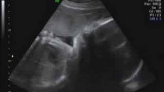 32 week ultrasound [upl. by Leuas]