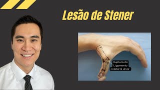 Lesão de Stener [upl. by Lombard]