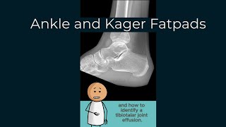 The Kager Fat Pad and Tibiotalar joint effusion [upl. by Odraleba]