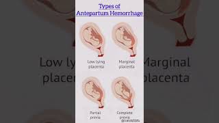 Types of Antepartum Hemorrhage  antepartumhemorrhage viralvideo [upl. by Ecinna]