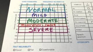 How to Read Your Audiogram [upl. by Gnod]