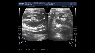 The localization of Acute Appendicitis in a child of 35 years [upl. by Yemerej489]