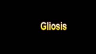 What Is The Definition Of Gliosis  Medical Dictionary Free Online Terms [upl. by Nonnair]