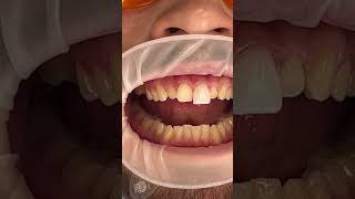 Veneers Process [upl. by Blakeley]