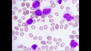 Acute myeloid Leukaemia with translocation 9 and 11 [upl. by Ostler117]