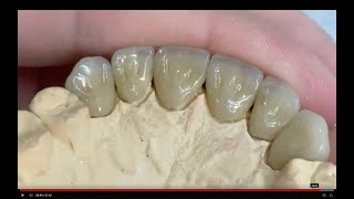 Zirconia Singles Anterior New Technique [upl. by Anelegna550]