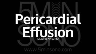 Pericardial effusion [upl. by Hakim]