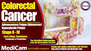 Colorectal Cancer Sings Symptoms And Treatment [upl. by Taima98]