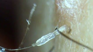 Squishy slimy ingrown hair and roots plucked under a microscope [upl. by Thecla]