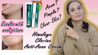 Himalaya Clarina AntiAcne Cream Review Hindi How to get clear skin HOW TO GET RID OF ANCE FAST [upl. by Giguere628]