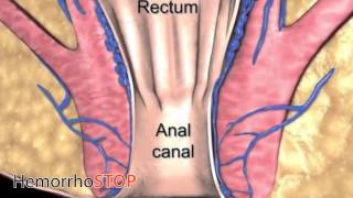 HemorrhoStop  Fast Hemorhroids Removal [upl. by Mohandas]