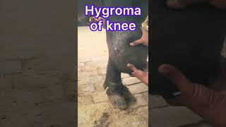 Hygroma of knee l Dr Umar Khan [upl. by Kizzie928]