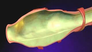 Bronchiectasis Animation  What is Bronchiectasis Videomp4 [upl. by Ayiotal]