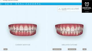 Invisalign Outcome Simulator  Invisalign Singapore by Dental Designs Clinic [upl. by Alle]