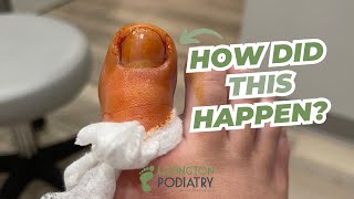 Partial TOENAIL Removal [upl. by Caassi]