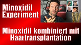 Haartransplantation wann Minoxidil Experiment Minox Haarverpflanzung Medical Exclusive [upl. by Cailean]