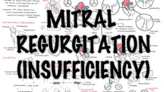 Mitral Reguritation insufficiency  Overview signs and symptoms pathophysiology treatment [upl. by Lexy]