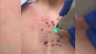 Keloid Scar Treatment [upl. by Silenay172]