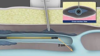 Radiofrequency Fibre In Action  RFA Vein Treatment [upl. by Conard]