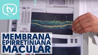 ¿Qué es y cómo se trata la membrana epirretiniana macular [upl. by Yim]