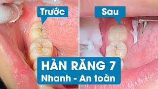 Hàn răng hàm răng số 7 bị sâu NHANH  AN TOÀN tại Nha Khoa Oze [upl. by Kylynn502]