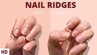 Nail Ridges The Silent Signaling Your Nails Are Trying to Tell You [upl. by Orvas]