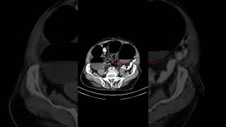 Sigmoid volvulus ctabdomen anatomy [upl. by Asa]