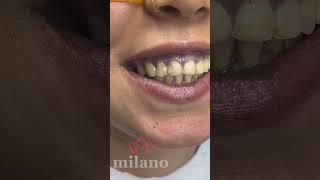 Emax Laminate Veneers in Turkey [upl. by Atiuqat]