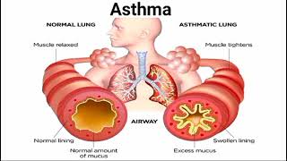 normal lung vs asthmetic lung  asthma symptoms  biology class 9 by Last moment tuitions [upl. by Notsua721]