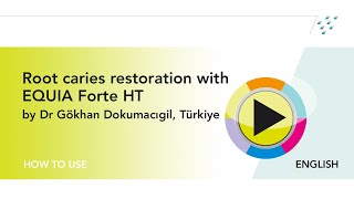 Root caries restoration with EQUIA Forte HT by Dr Gökhan Dokumacıgil Türkiye [upl. by Ecnerual]