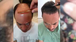 Dr Pittella • Another Norwood 7 maybe 6 Big forehead average donor wavy thicky Hair [upl. by Narcho]