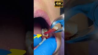 How can a simple abcessed turn into root canal or tooth loss toothextraction rootcanaltreatment [upl. by Cleave]