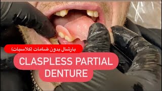 MAKING PARTIAL DENTURE WITHOUT CLASPS FLIPPER ALL STEPS FROM CAST TO INSERTION waxbae flipper [upl. by Nov414]