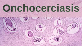 What is Onchocerciasis  Pathology mini tutorial [upl. by Areehs]