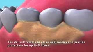 PerioPatch Topical Patch for Gingival Repair [upl. by Alrak]