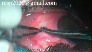 Conjunctival Graft Suturing For Pterygium Excision With Autograft By Dr Sudhir Singh 33 [upl. by Ellirehs]